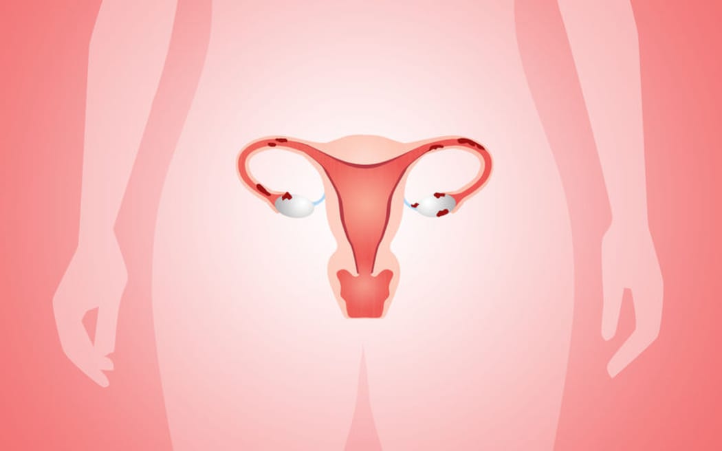 Can pelvic floor physiotherapy help with symptoms of endometriosis?