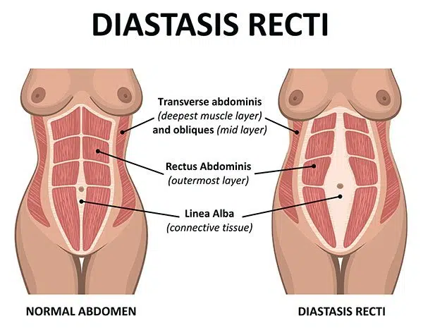 Diastasis Recti Variations