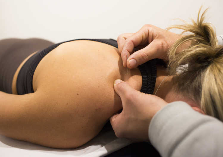 Dry needling vs acupuncture - what’s the difference?