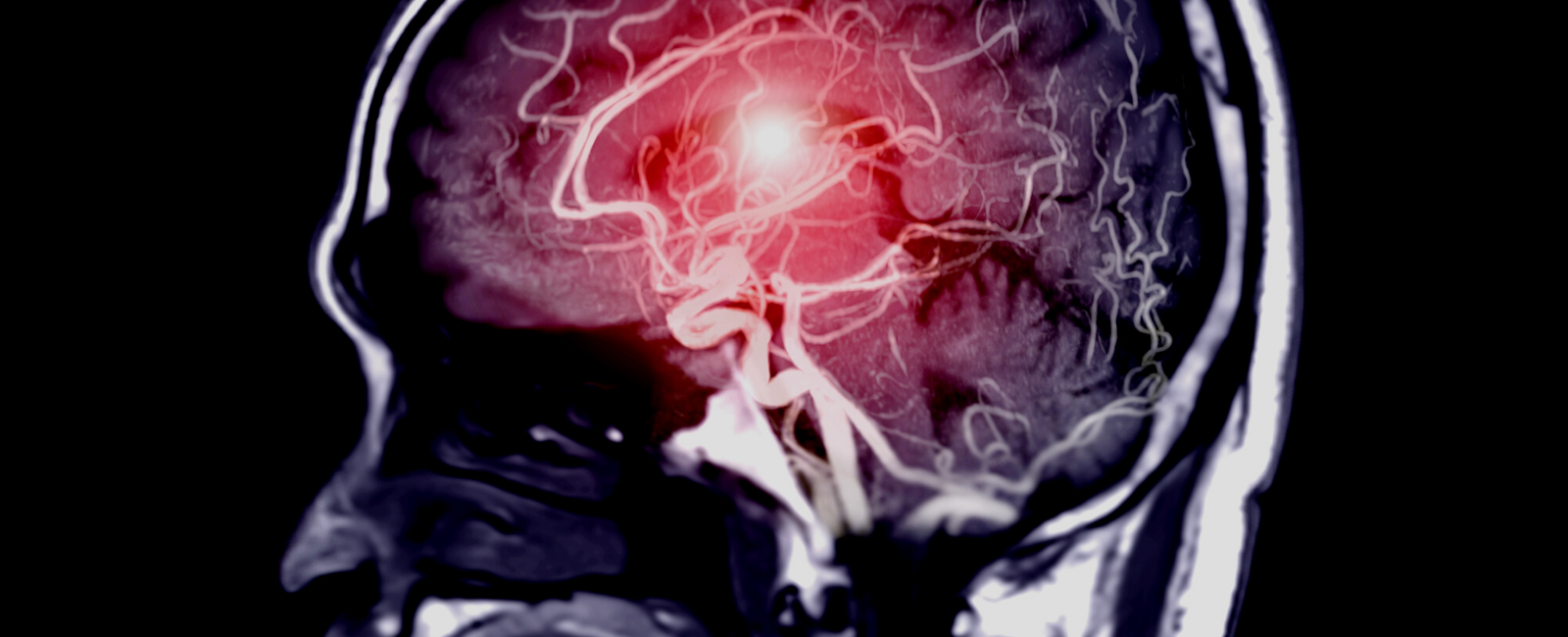 Intravenous Magnesium as a Possible Therapy for Cerebral Ischemia