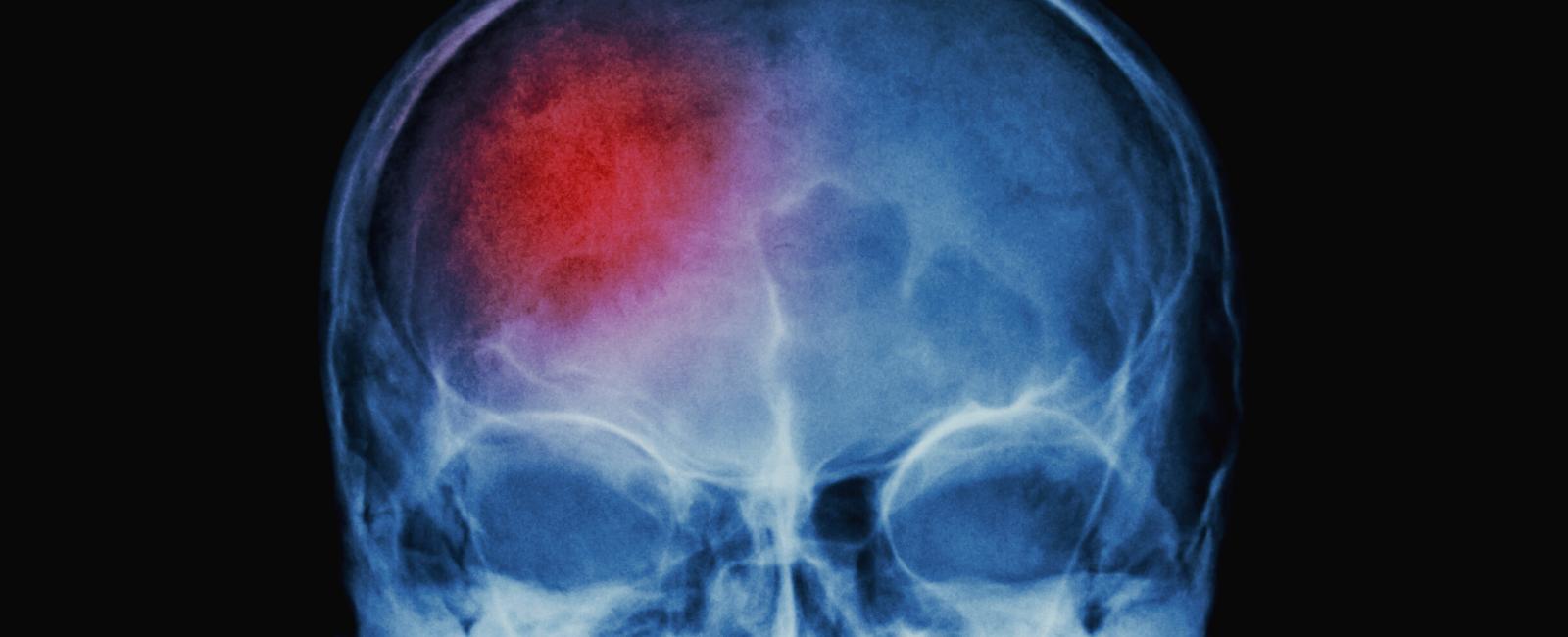 The Relationship Between Magnesium Sulfate, Cerebral Ischemia, and Subarachnoid Hemorrhage