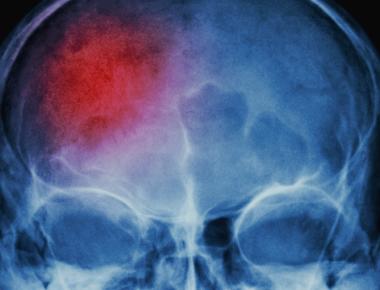 The Relationship Between Magnesium Sulfate, Cerebral Ischemia, and Subarachnoid Hemorrhage