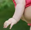 Hitzepickel auf Babys Arm