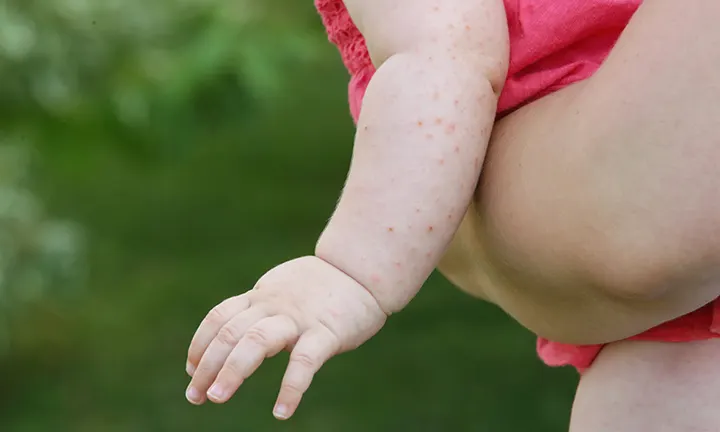Hitzepickel auf Babys Arm