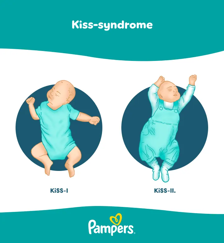 KiSS-Syndrom: Ursachen & Symptome beim Baby | Pampers DE