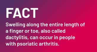 Fact - Swelling along the entire length of a finger or toe, also called dactylitis, can occur in people with psoriatic arthritis