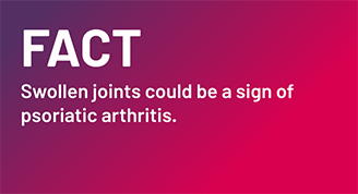 Fact - Swollen joints could be a sign of psoriatic arthritis.