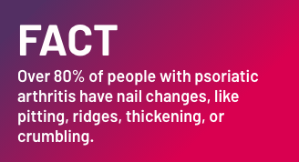 Fact - Over 60% of people with psoriatic arthritis have nail changes, like pitting, ridges, thickenin, or crumbling.