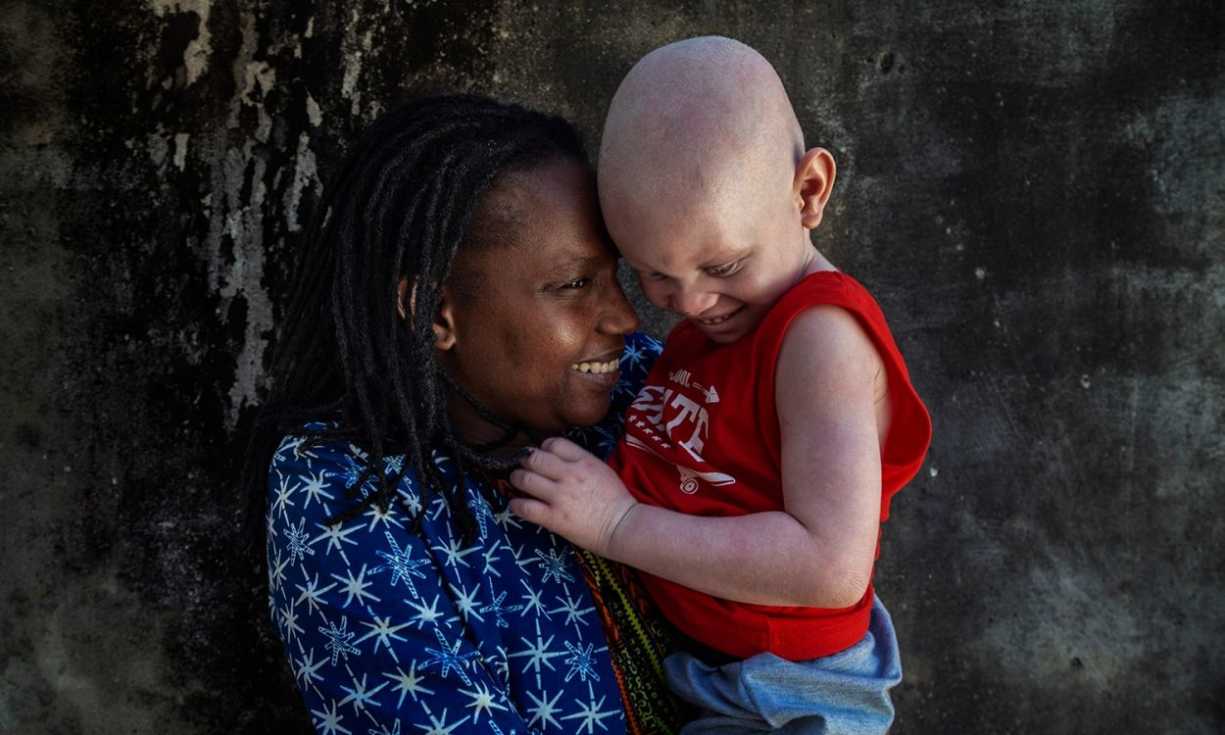 Flavia Pinto holds Elisio, a toddler with albinism who she is in the process of adopting