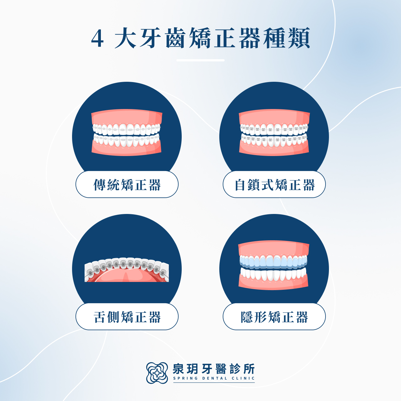 4 大牙齒矯正器種類
