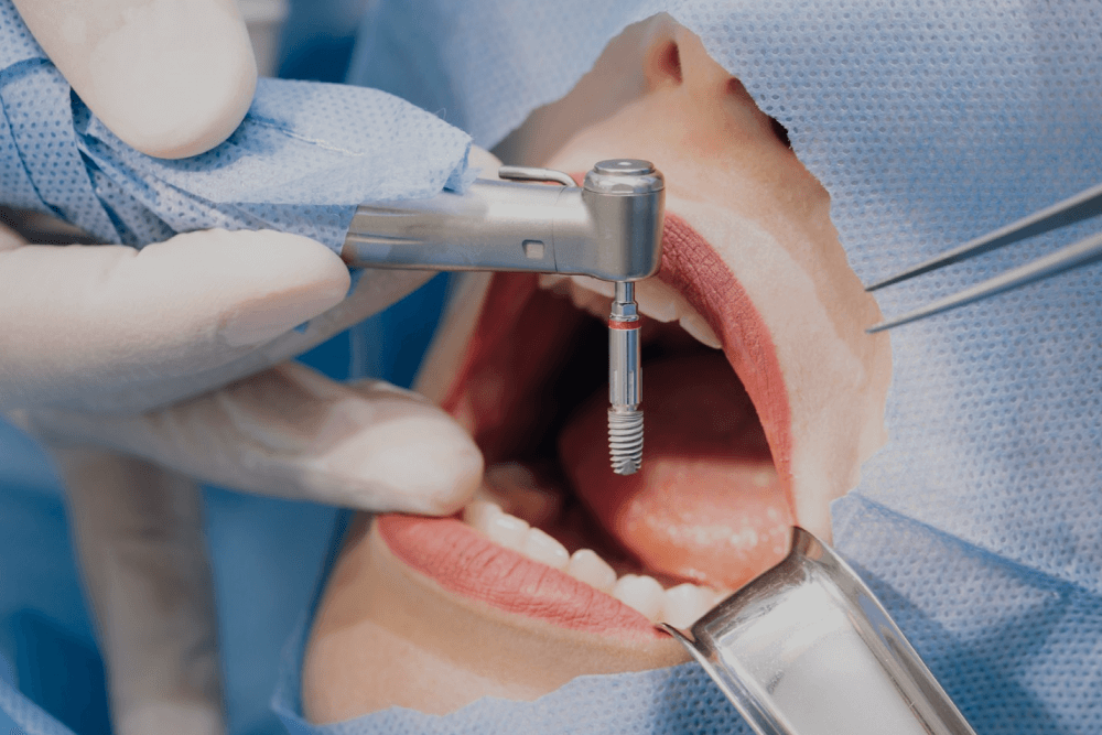 植牙前必讀！植牙是什麼？植牙手術流程、注意事項詳解