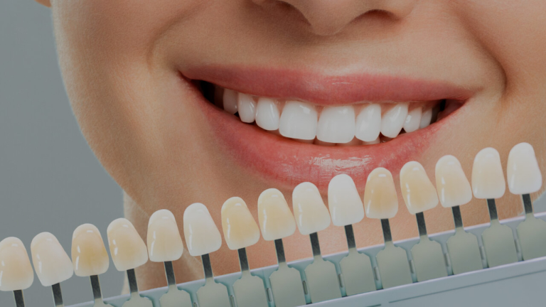牙齒美白全攻略！市面 10 大牙齒美白方法、費用、常見問題一次收