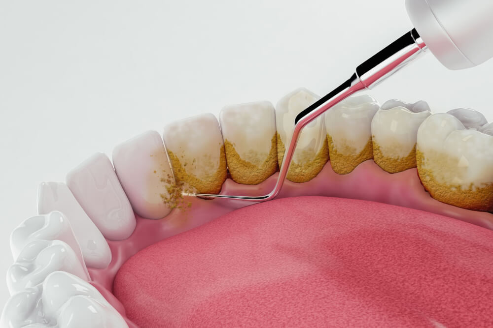 牙周病重點整理｜解析牙周病症狀、成因及改善方法