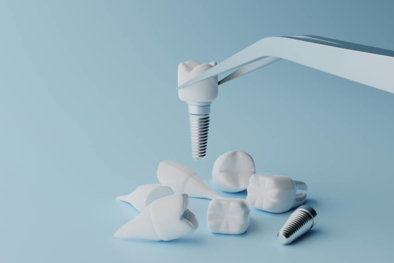 什麼是微創植牙？微創植牙手術過程、費用、推薦診所全解析！							