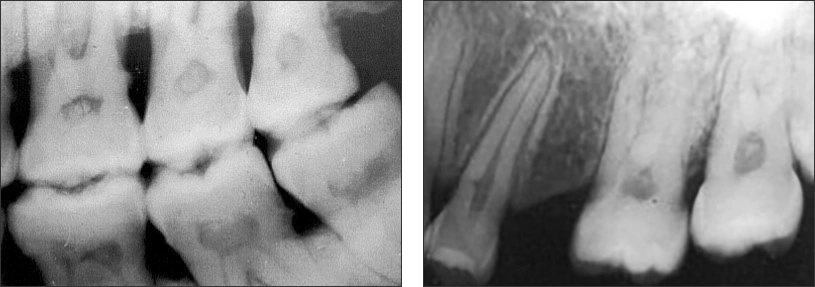 Bitewing and periapical radiographs showing posterior pulp stones of varying sizes