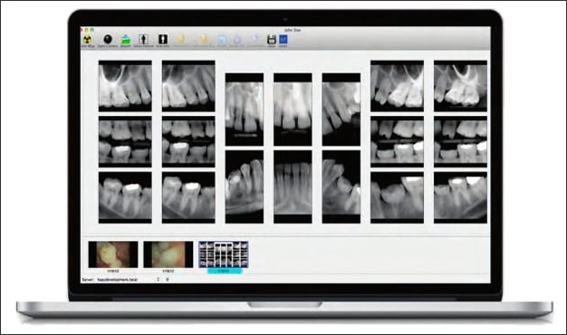 Photograph showing image of laptop displaying digital full-mouth images.
