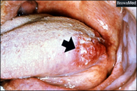 Photo showing squamous cell carcinoma of the tongue.