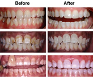 Tooth Whitening - Figure 3