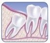 Patient Material - Wisdom Teeth Pain and Removal - Image01