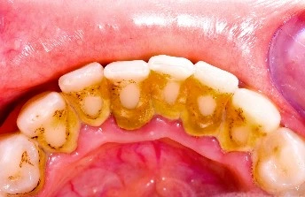 Patient Material - Tartar on Teeth - Image2