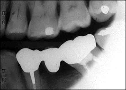 radiograph of round cone cut