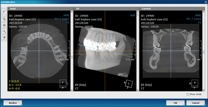 Photograph showing 3D Dental Implant Treatment Planning.