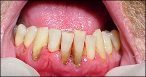 gum recession chewing tobacco Oral Implications of Chewing Tobacco Use/Abuse - An Introduction to  Substance Use Disorders for Dental Professionals