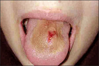 Image: Infection at the piercing site.