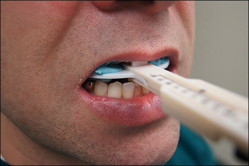 Dental Impressions and Bite Registration - Figure 1