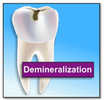 Animation depicting demineralization and remineralization