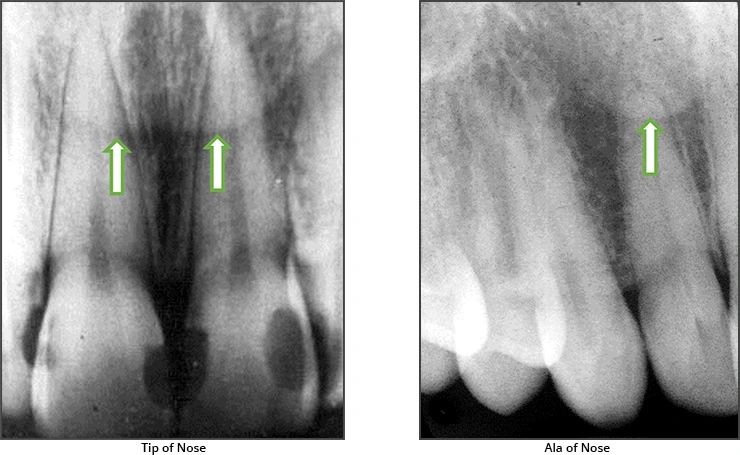 Maxillary Anterior Landmarks - Figure 9