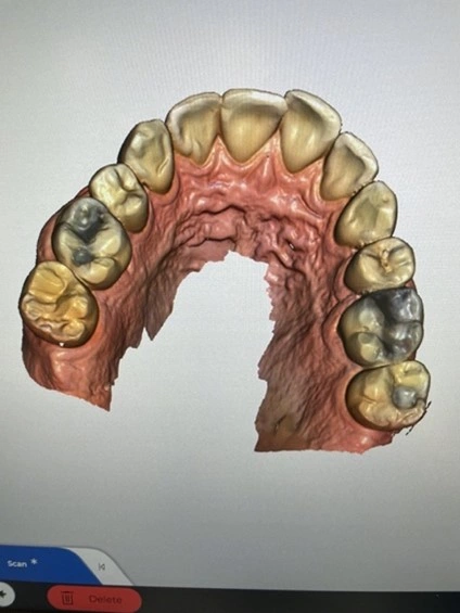 The maxillary arch has been digitally scanned. Repeat with the mandibular arch. 