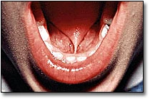 ce4 - Content - Ankyloglossia - Figure 2