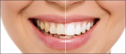 Tooth Whitening - Figure 5