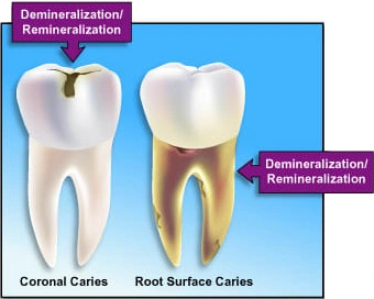 Illustration depicting demineralization and remineralization