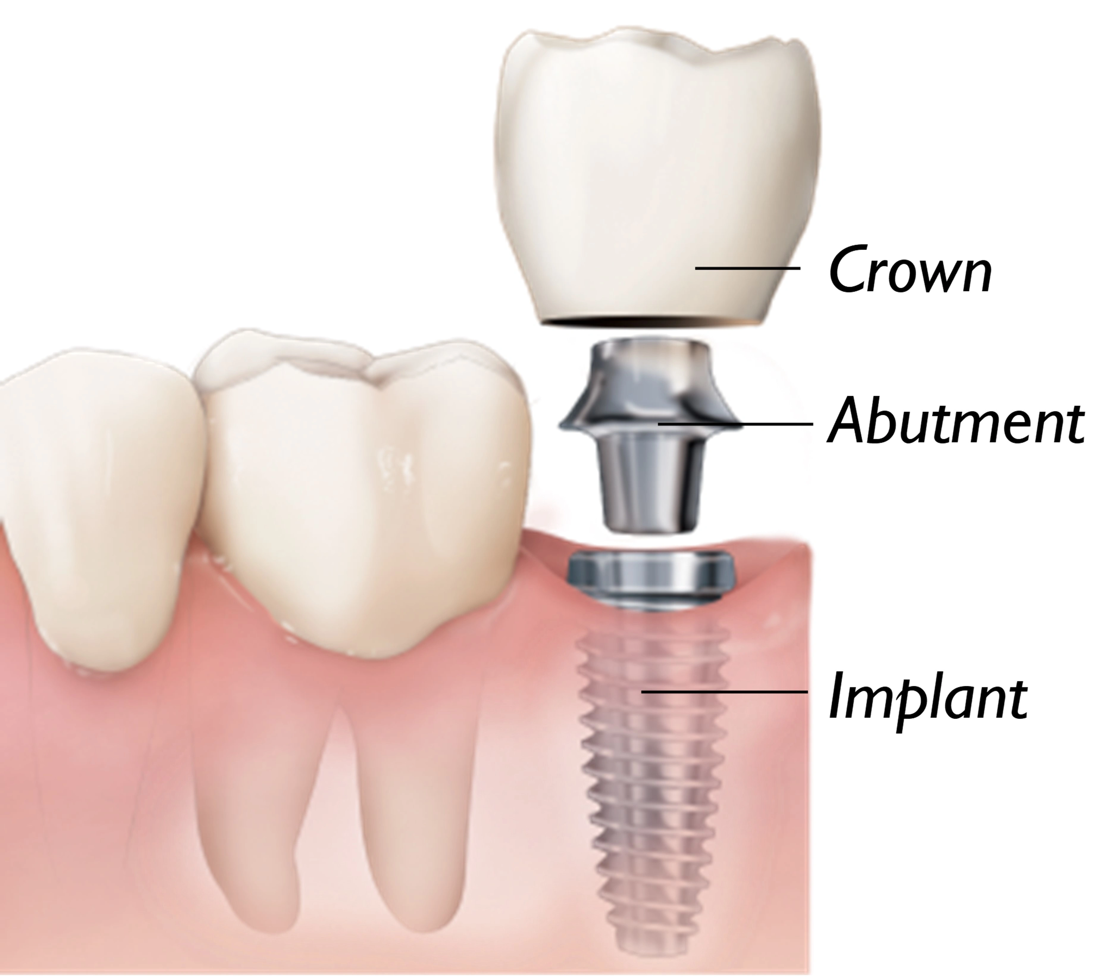 ce542 - Content - Implants - Figure 1