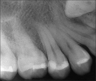 Dilaceration of tooth #6 secondary to impingement of an adjacent impacted tooth