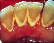 Patient Material - Tartar on Teeth - Image4