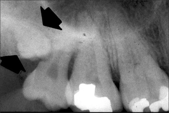 Alterations in the Number of Teeth - Figure 5