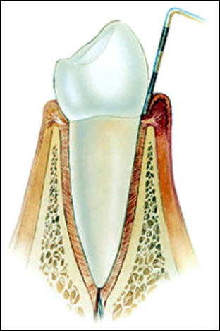 ce542 - Content - Characteristics of Gingivitis - Figure 2