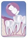 Patient Material - Wisdom Teeth Pain and Removal - Image3