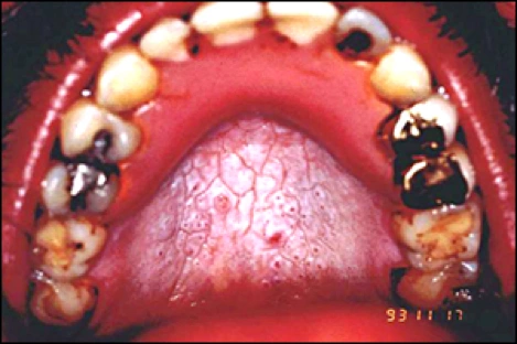 Photo showing nicotine stomatitis.