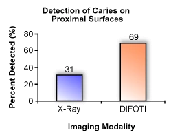 Chart showing the detection percentage of caries on proximal surfaces between xrays and DIFOTI
