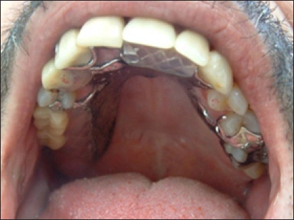 Dentures - Figure 1