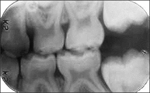 Primary and Permanent Dentition Eruption Sequences - Figure 2