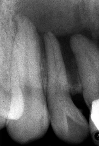 Periapical radiograph of tooth #7 with dens invaginatus Type I