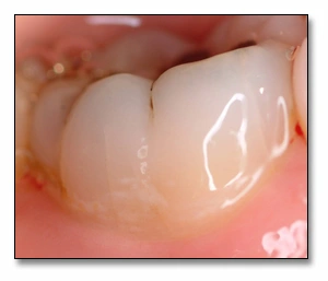 Photo showing an example of early white spot lesion on buccal surface