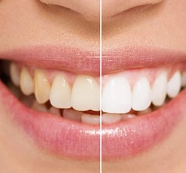 Teeth Whitening – Dental Care