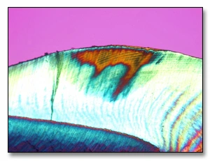 Image of a polarized-light micrograph of an early enamel subsurface lesion.