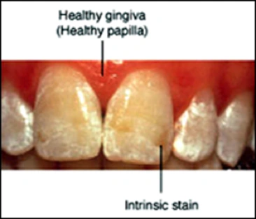 Tooth Whitening - Figure 2